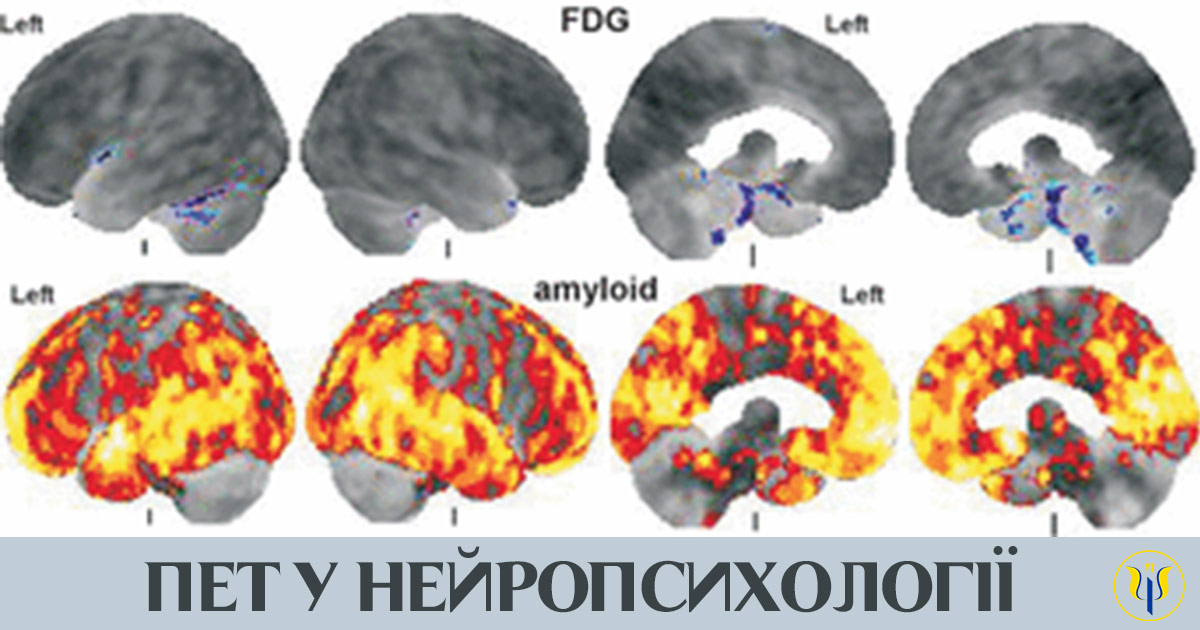 Позитронно емісійна томографія у нейропсихології